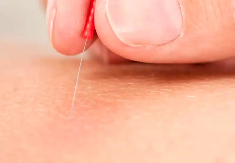 Kuru İğne Uygulaması