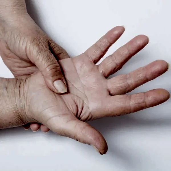 El Terlemesinde Anestezi