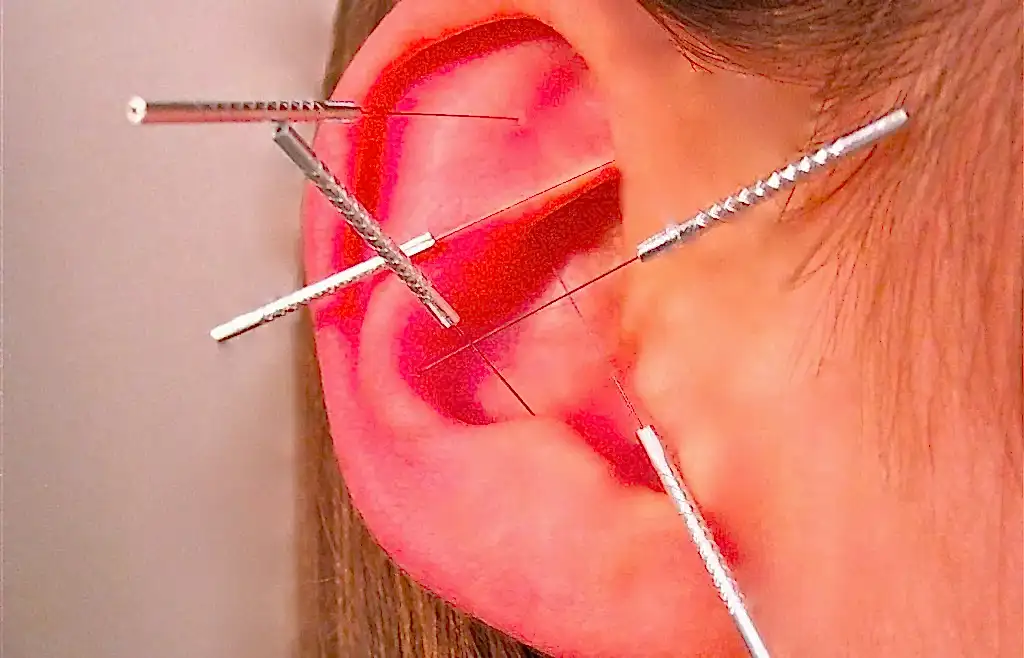 Akupunktur İle Zayıflama Tedavisi