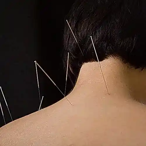 Akupunktur İle Boyun  Fıtığı Tedavisi