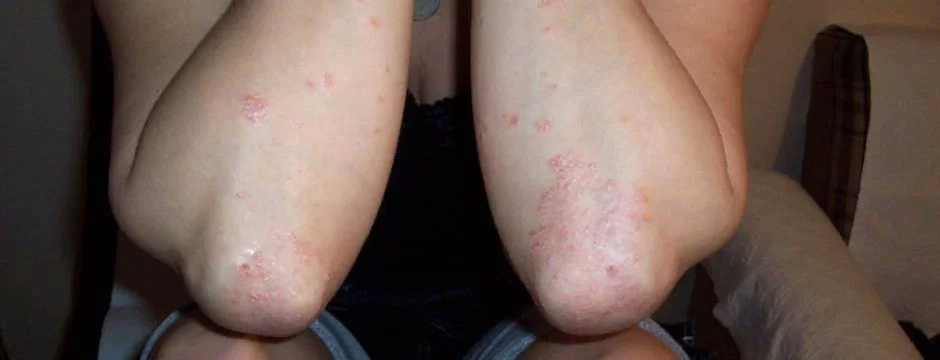 Akupunktur İle Egzama Tedavisi