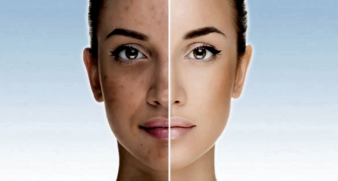 Akne ve Akne İzi Tedavisinde Mezoterapi