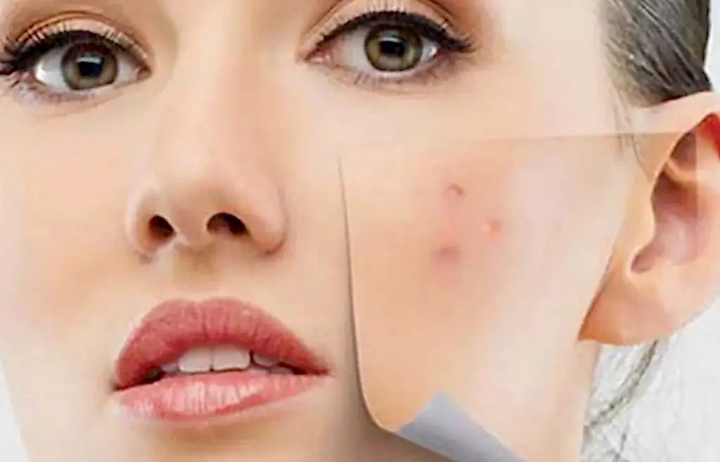 Leke Tedavisinde Mezoterapi