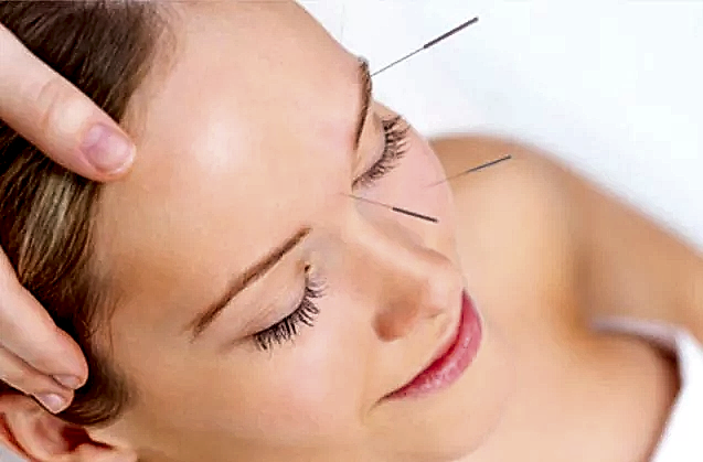 Cilt Gençleştirmede Kozmetik Akupunktur