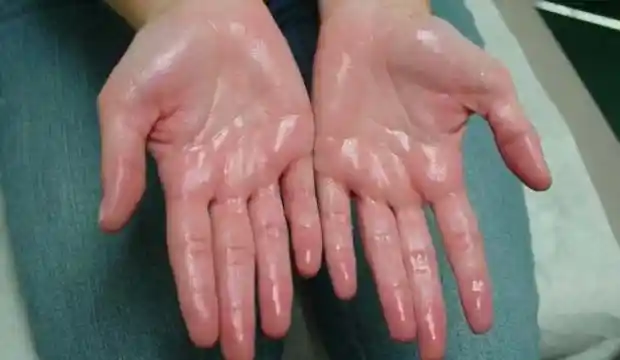 El Terlemesinde Akupunktur Tedavisi