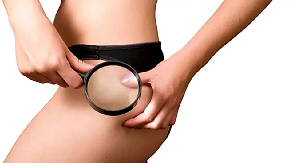 Selülit Tedavisinde Ozon Terapi